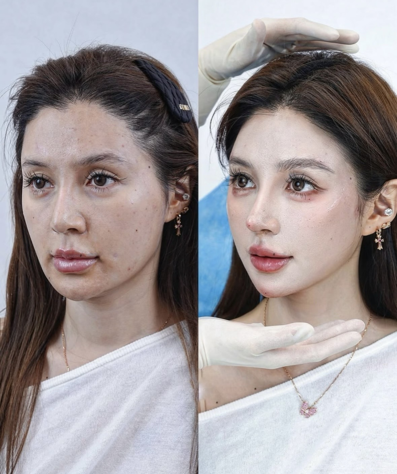 四、眼袋脂肪填充眼窝成活率相关解析