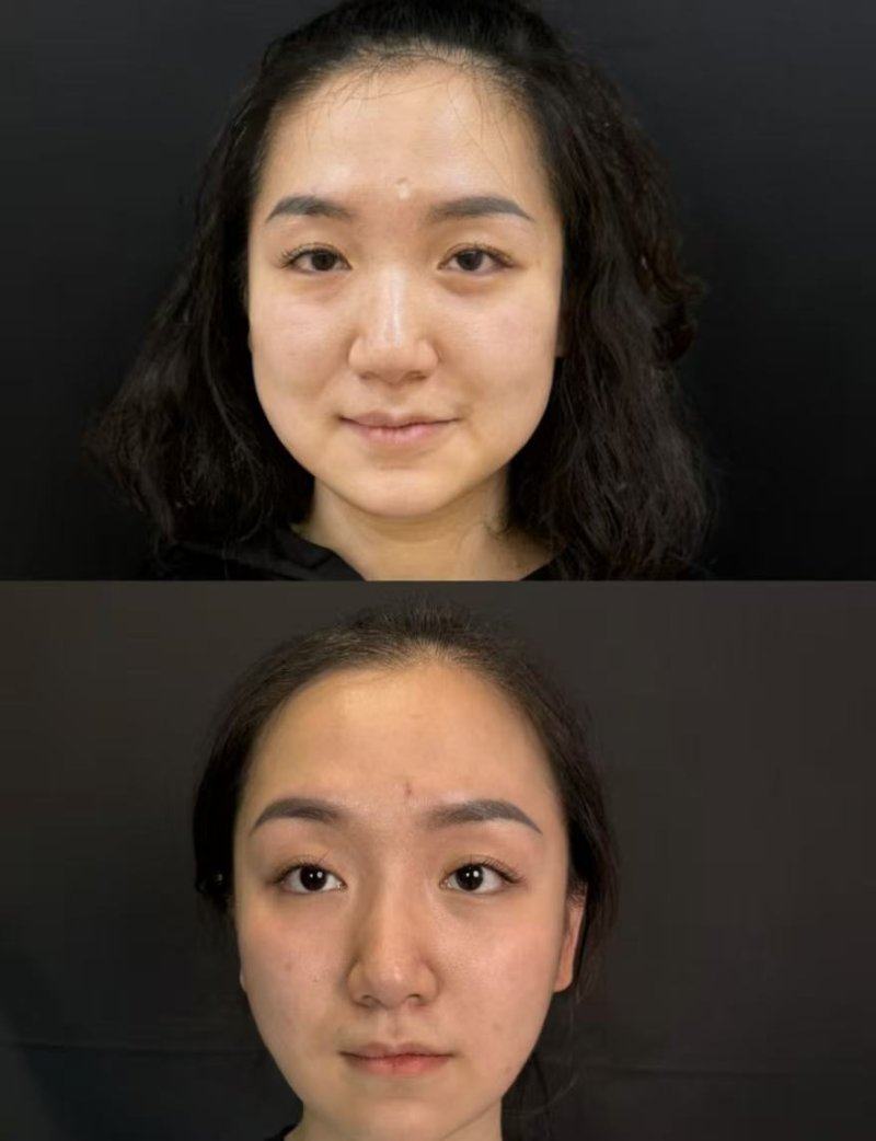 三、填眼袋用脂肪填充能保持多长时间不移位