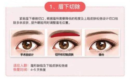 二、天生双眼皮的典型特征