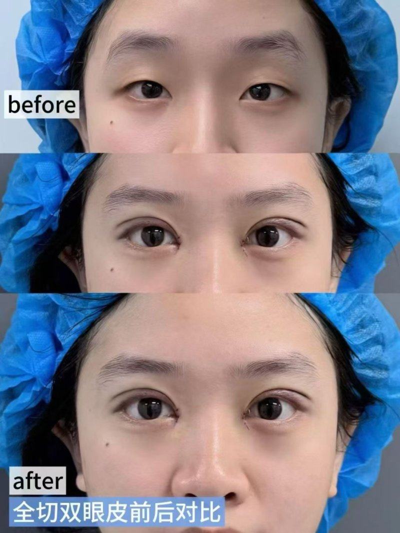 三、点阵激光:凹陷性疤痕的主流修复方案