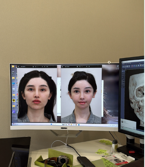 三、腰部吸脂的疼痛与修复周期