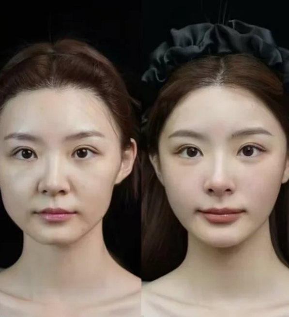 三、假性双眼皮的特征与诱因