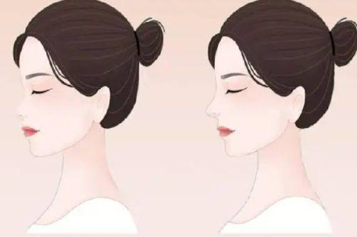 二、为什么单做割双眼皮容易显老？