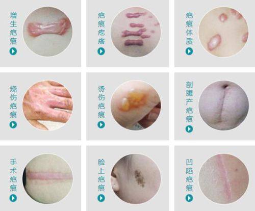 三、阑尾手术疤痕的合格判定细节