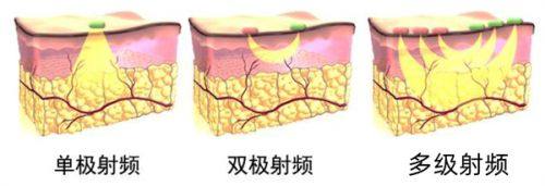 二、不适合单独用于淡化陈旧性疤痕的药膏
