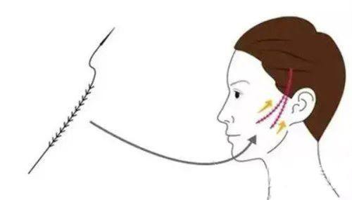 六、理线双眼皮的护理与风险提示