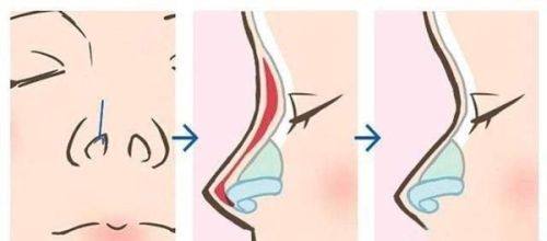 三、医美有效治疗熬夜眼袋的专精方案