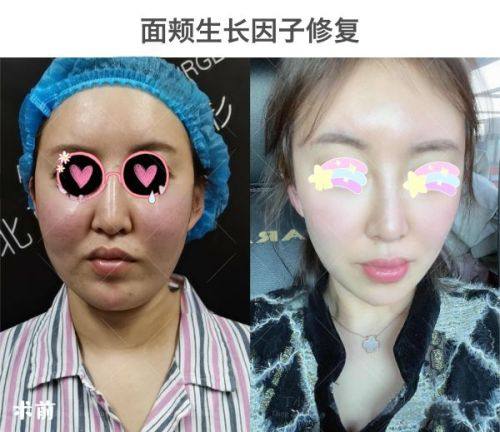 四、去眼袋打针打的是什么