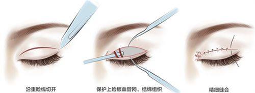 五、四款热门去眼袋针剂详细解析