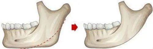 四、不同程度水痘坑的适配方案选择