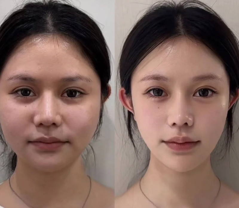 五、水痘坑修复的长期维持技巧